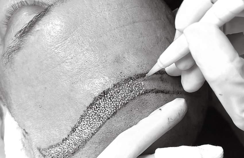 DHI Haartransplantation