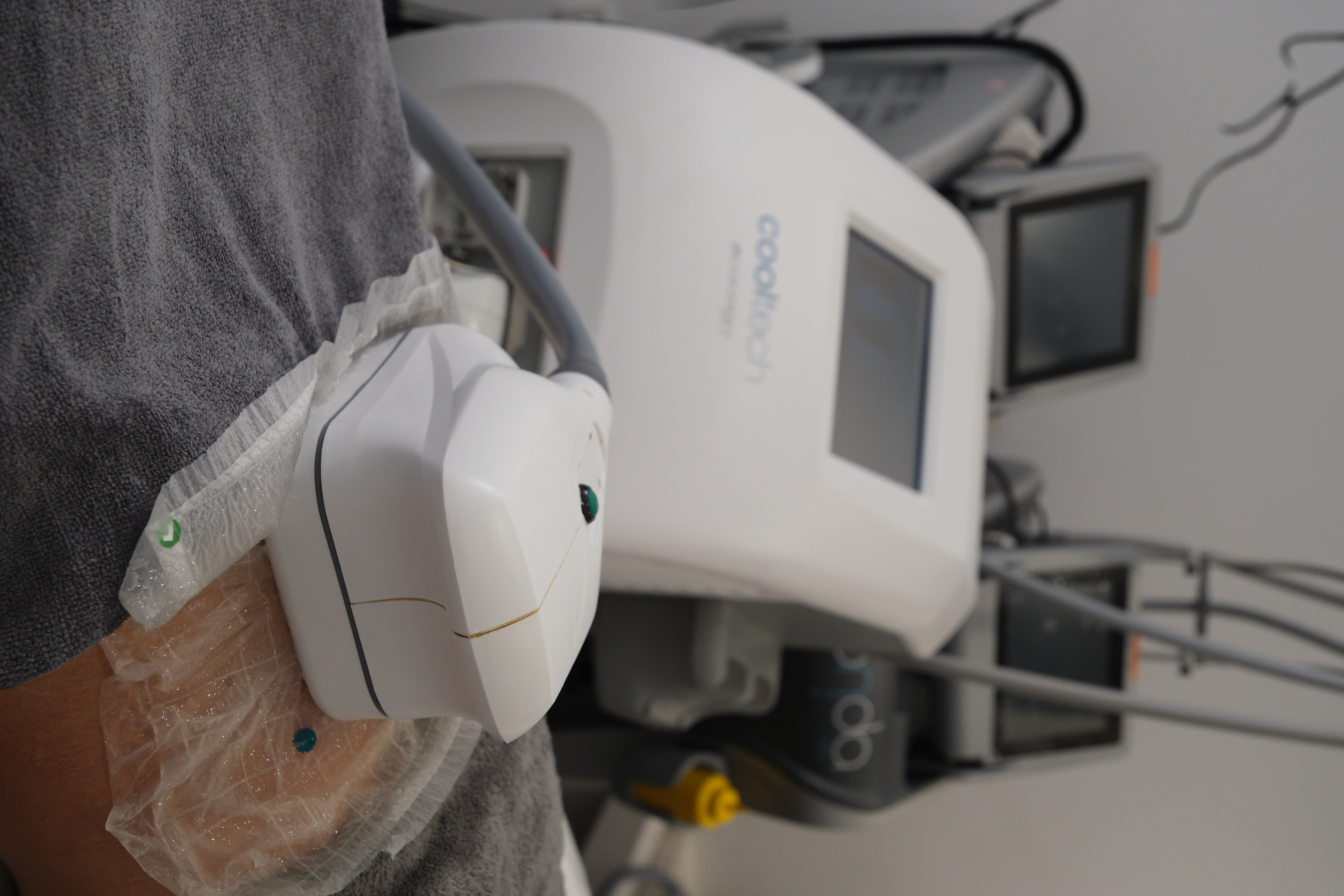 Cold lipolysis applicator placed on the abdominal area at Zen Polyclinic