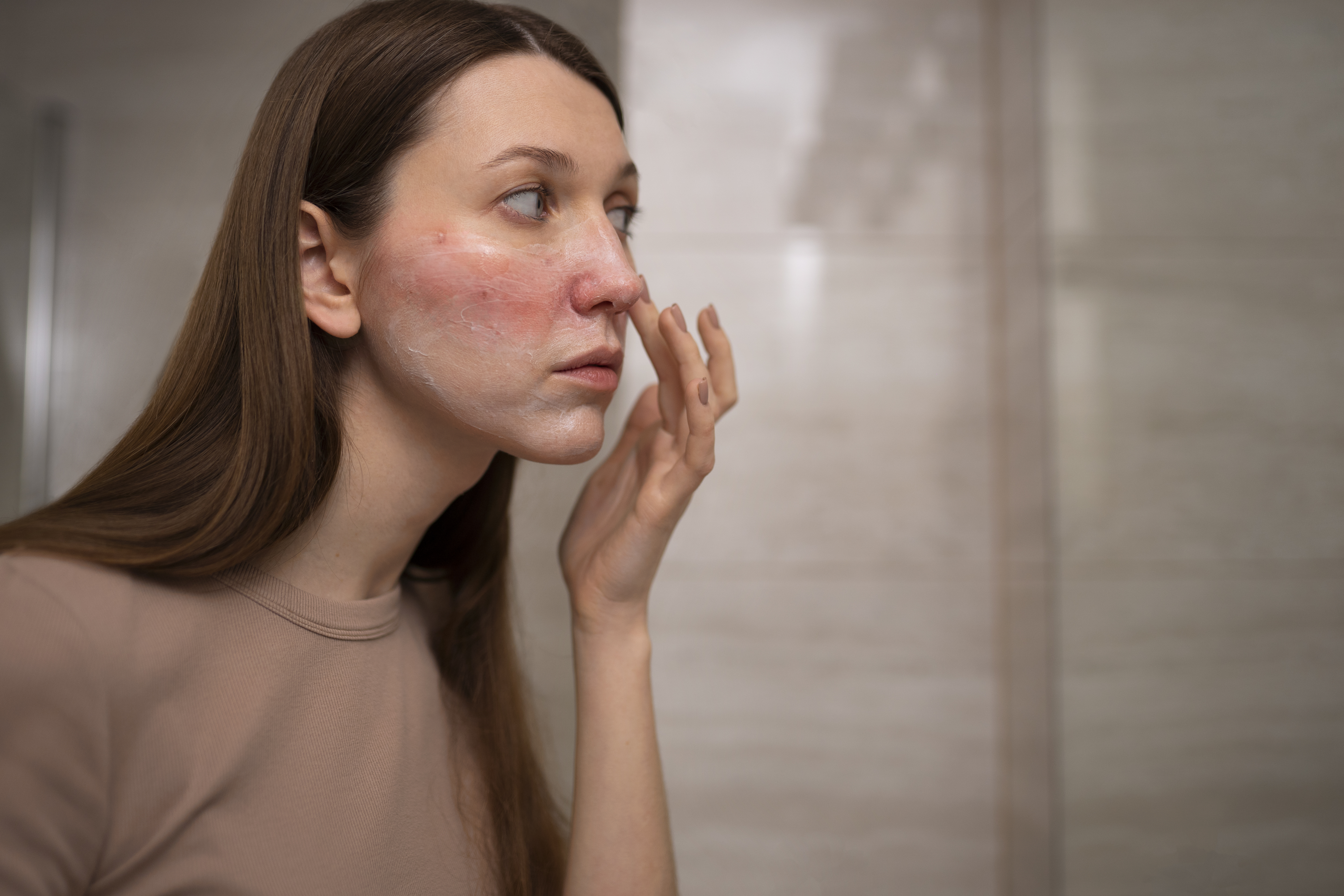Rosacea-Behandlung