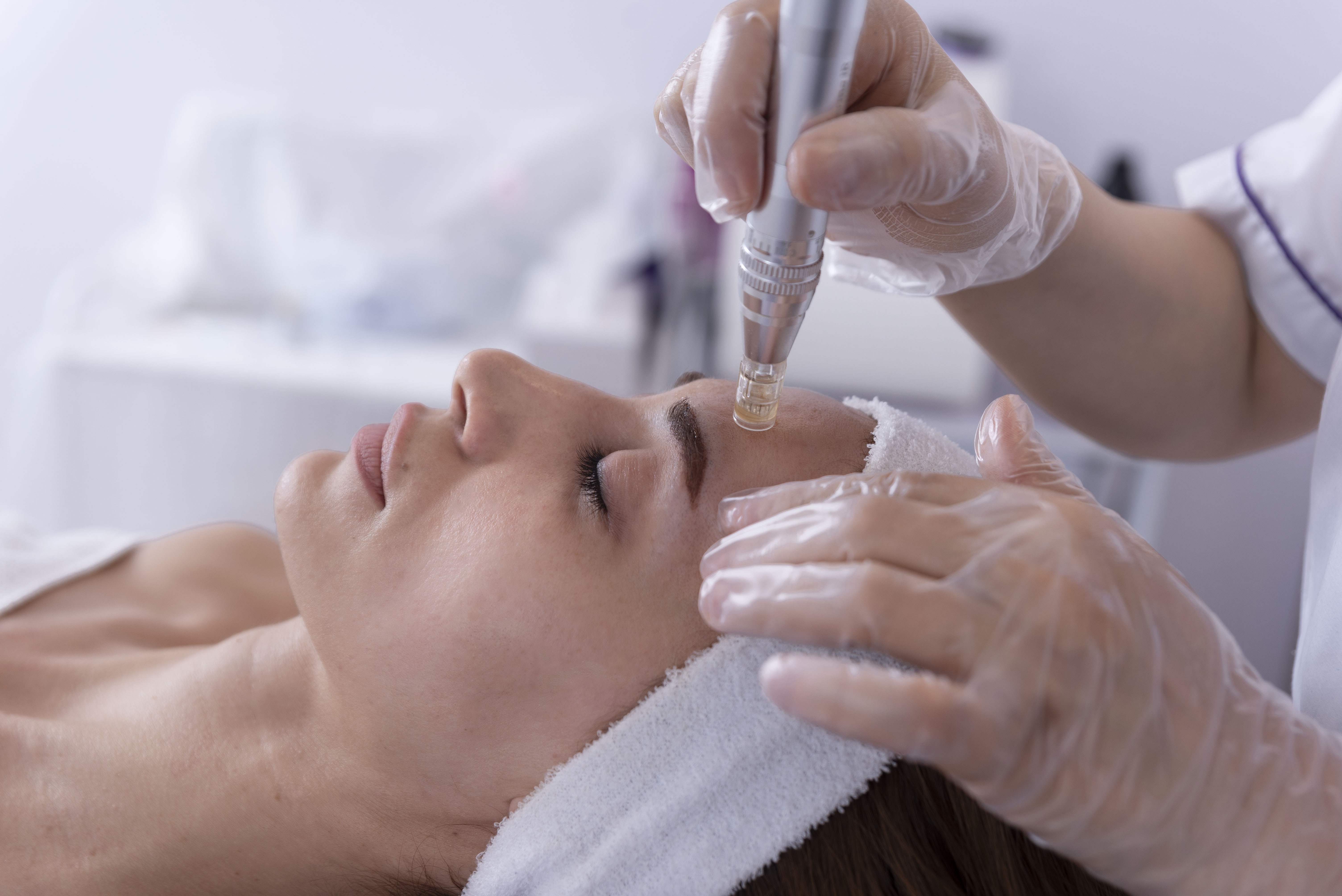 Dermapen Microneedling Anwendung in der Zen Poliklinik