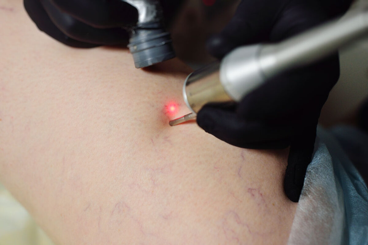 Gefäßselektive Laseranwendung an erweiterten Äderchen