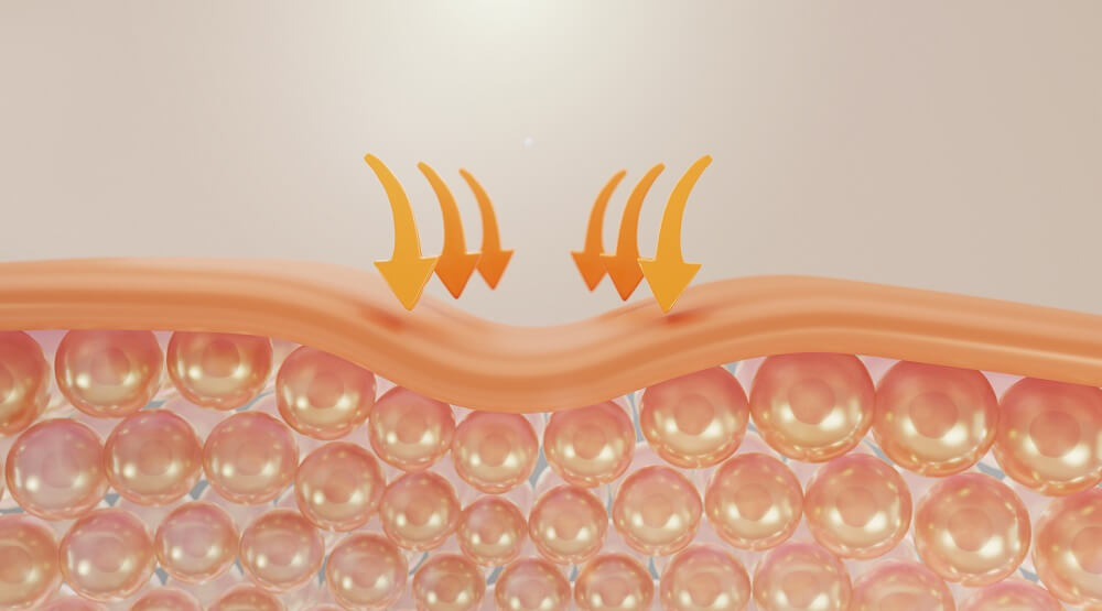 Close-up illustration of skin structure and wrinkle formation