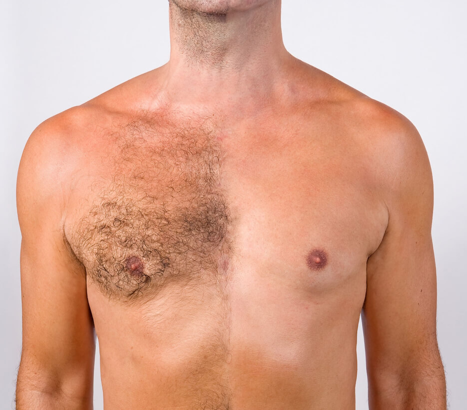 The most preferred areas for laser hair removal in men