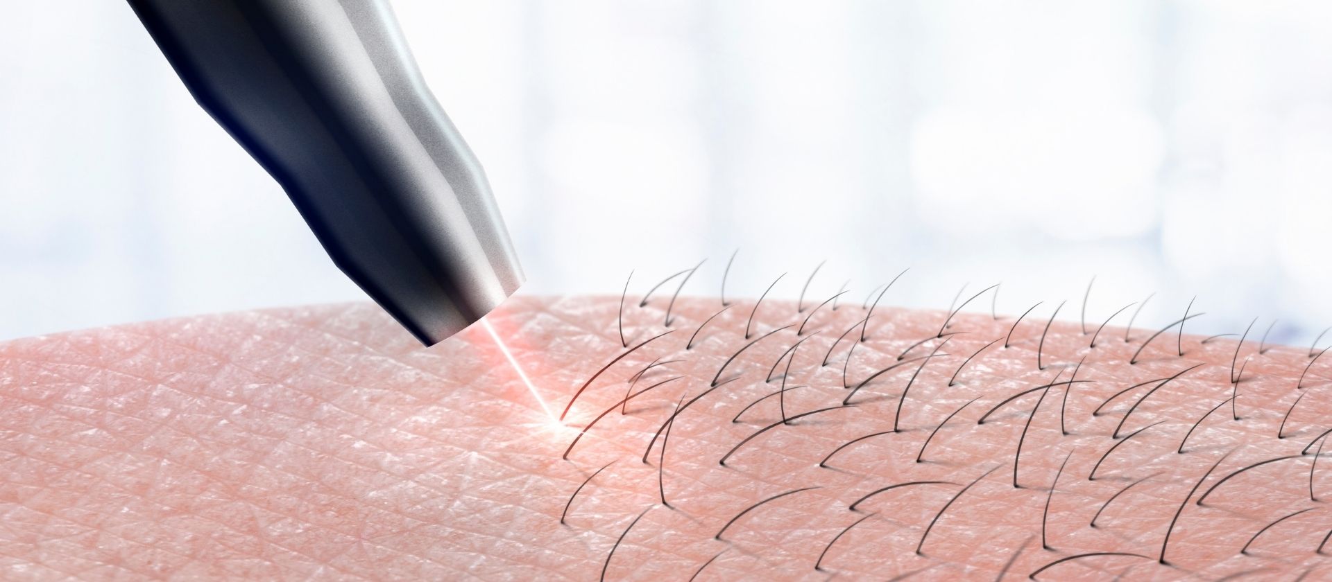Painless laser hair removal application and Soprano Ice Platinum ice laser technology