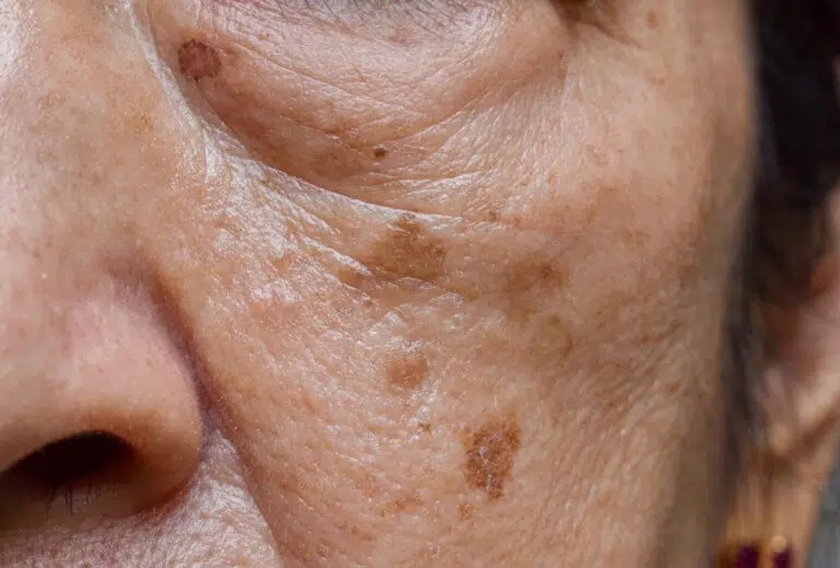 Cilt lekesi türleri