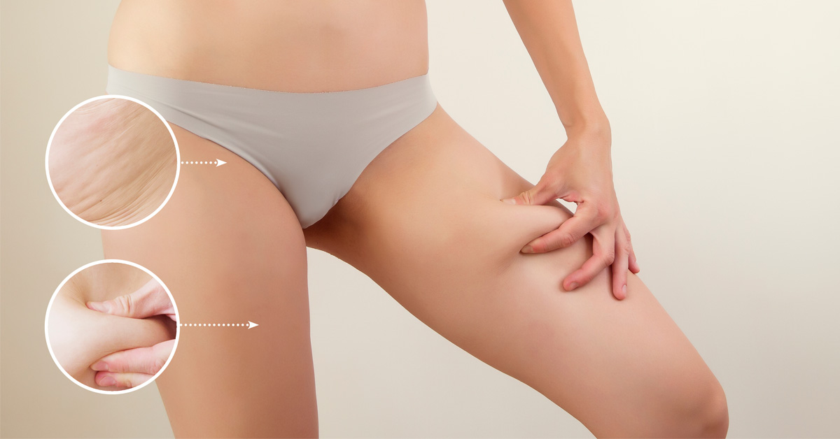 cellulite types and stages