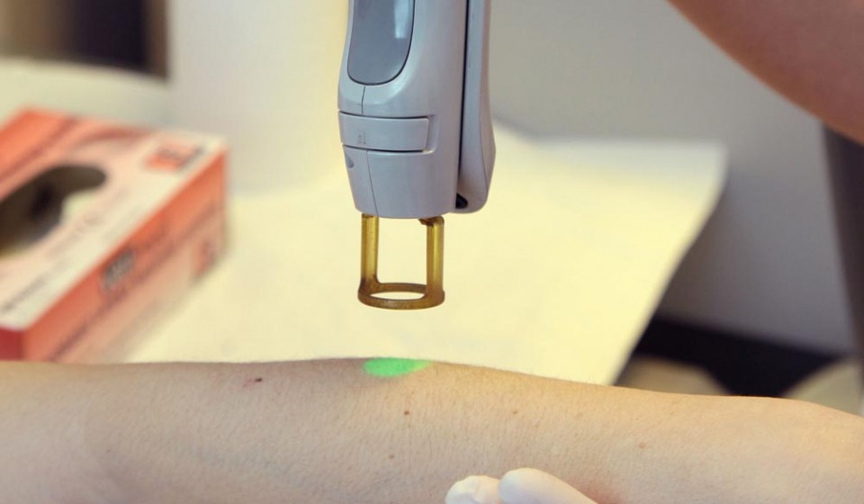 Lazer epilasyonda kullanılan Alexandrite lazer cihazı