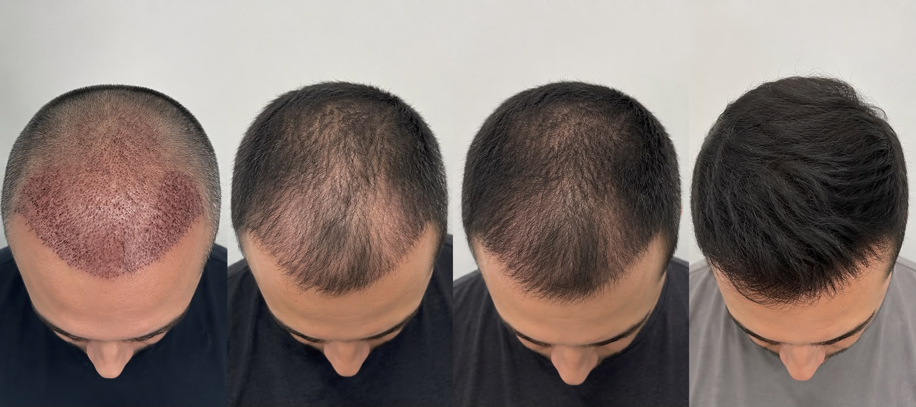 Post-hair transplant follow-up and support treatment at Zen Polyclinic