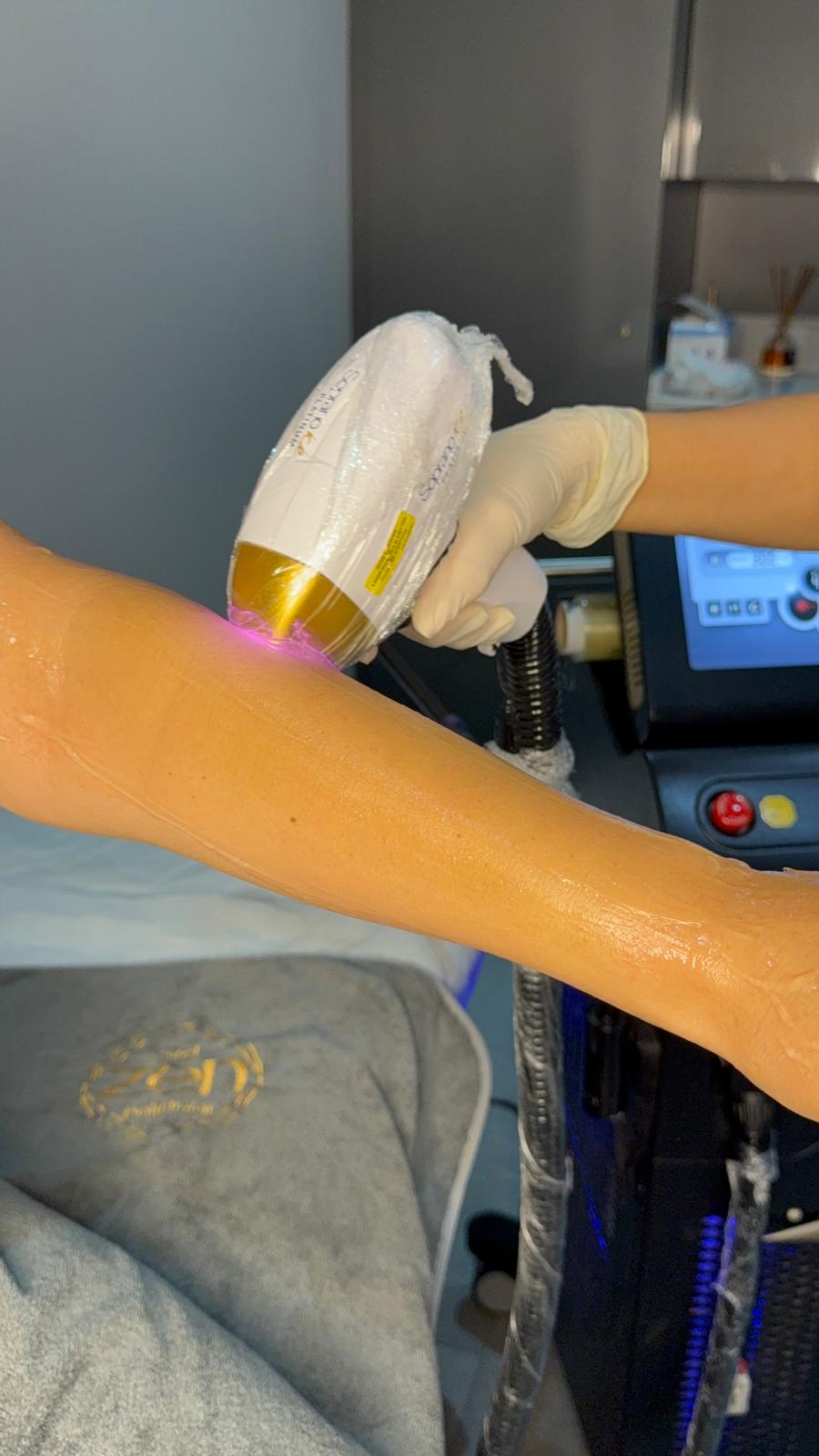 assessment of laser hair removal on blonde and white hair