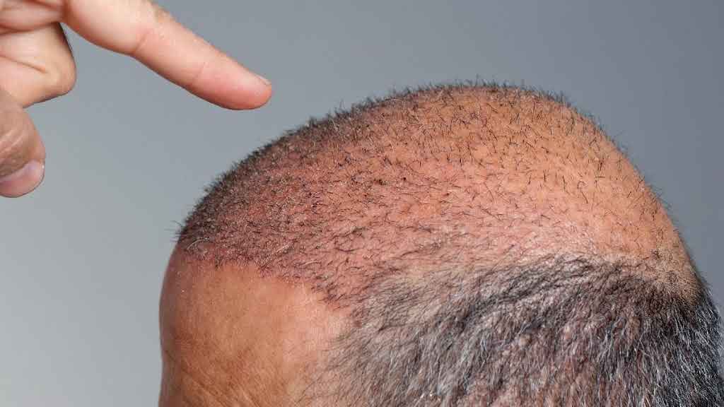 Hair shedding during the shock loss period after hair transplant