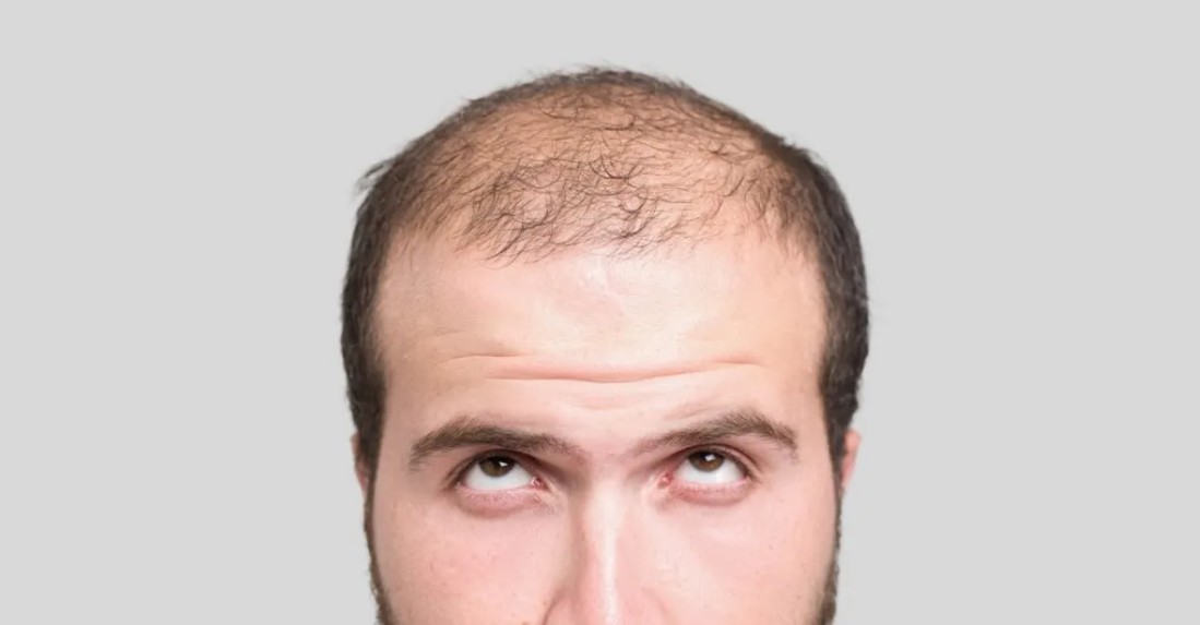 Example image illustrating the shock loss process after a hair transplant