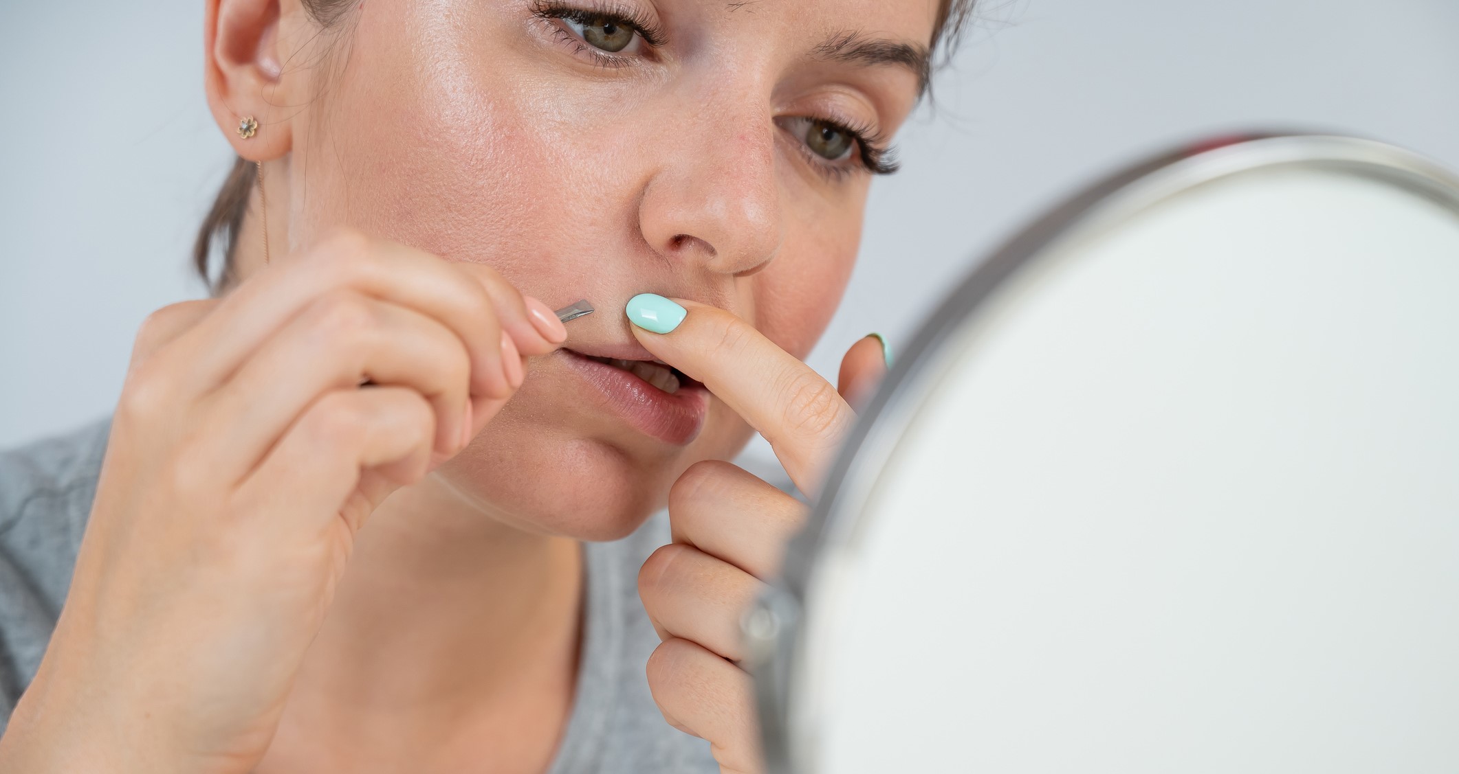 Ansatz der Laser-Haarentfernung bei Hirsutismus und PCOS