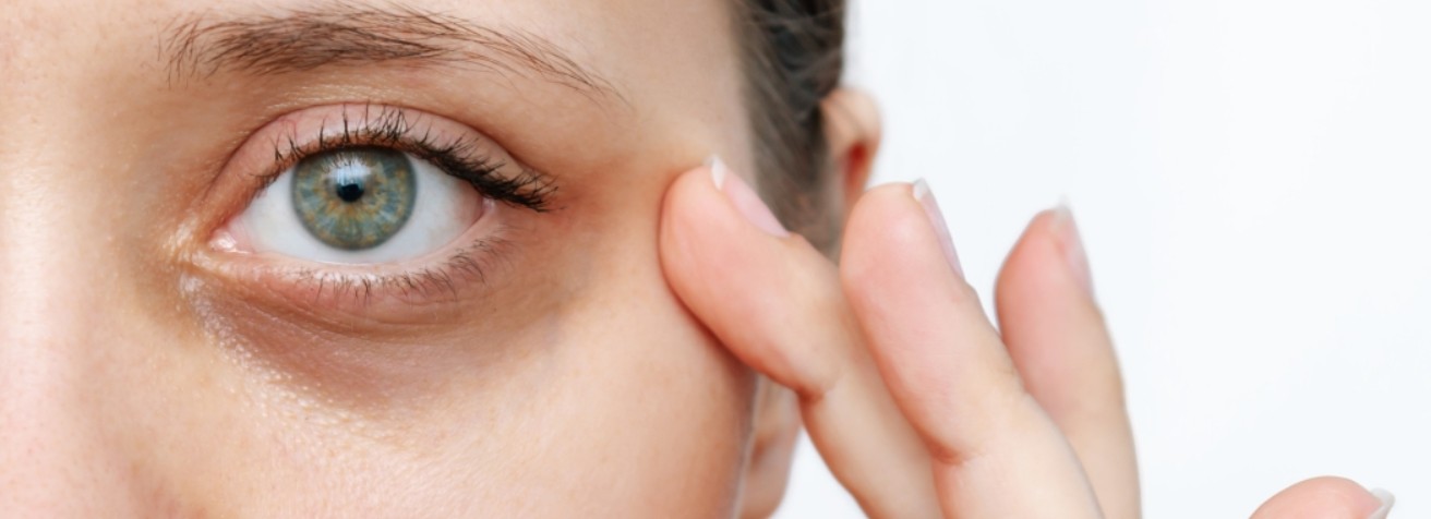 Appearance of under-eye hollows (tear trough)