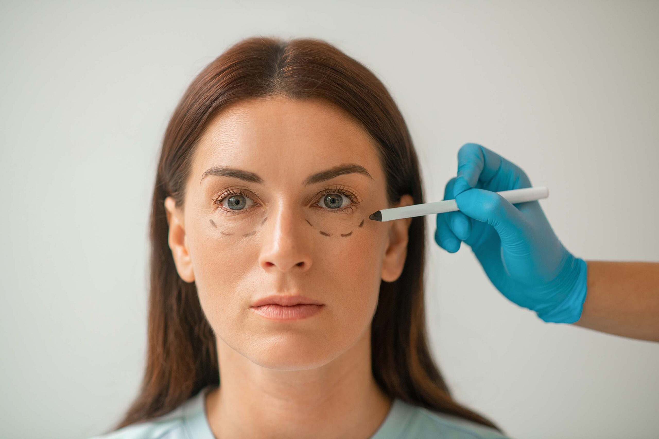 Comparison of under-eye bags and under-eye hollows