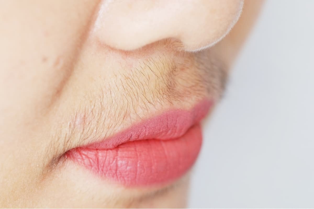 Hormonelles Haarwachstum bei Frauen und Ablauf der Laser-Haarentfernung