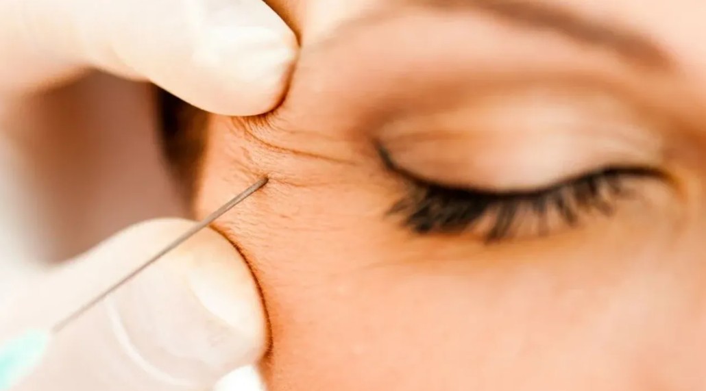Eyelid drooping symptom after Botox ptosis